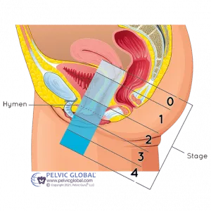 Pelvic Floor PT - Hymen - Inspira PT