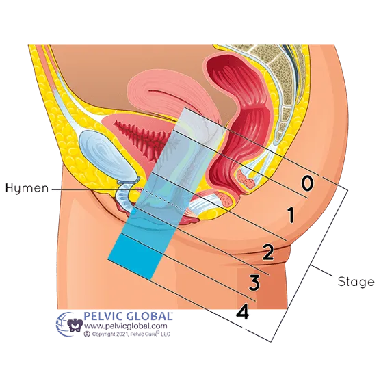 Pelvic Floor PT - Hymen - Inspira PT